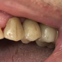 Ponte in zirconio ceramica