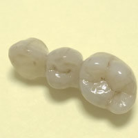 Ponte in zirconio ceramica
