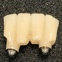 Ponte in zirconio ceramica avvitato su impianti