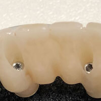 Ponte in zirconio ceramica avvitato su impianti