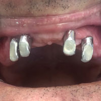 Telescopiche su impianti