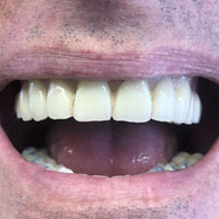 Telescopiche su impianti